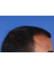 Before Hair Transplant&nbsp;Front